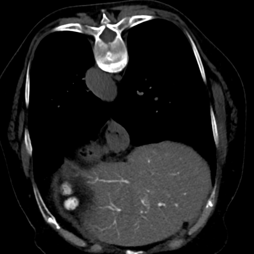 Ampullary adenocarcinoma (Radiopaedia 34013-35241 C 16).png