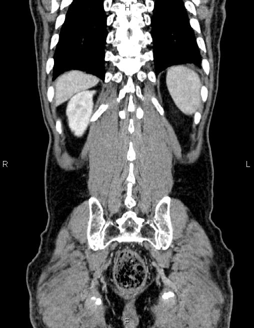 Ampullary adenocarcinoma (Radiopaedia 86093-102032 C 58).jpg