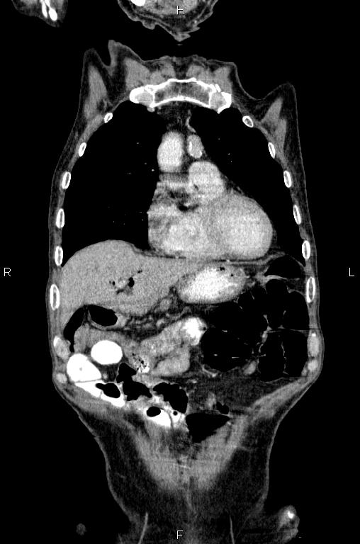 Ampullary adenocarcinoma (Radiopaedia 86093-102033 D 14).jpg