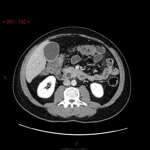 Ampullary carcinoma (Radiopaedia 56396-63056 C 49).jpg
