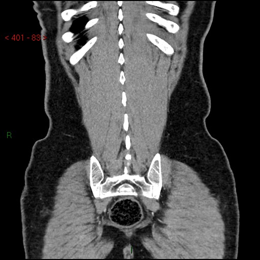 Ampullary carcinoma (Radiopaedia 56396-63056 E 82).jpg