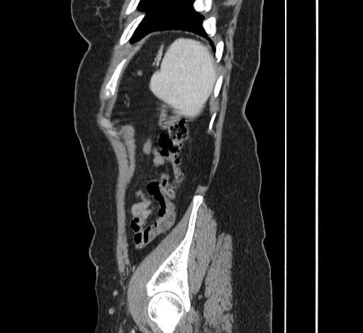 File:Ampullary tumor (Radiopaedia 60333-67998 C 53).jpg