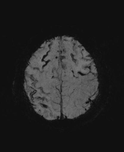 File:Amyloid angiopathy with inflammation (Radiopaedia 30360-31002 Axial SWI MIP 51).jpg