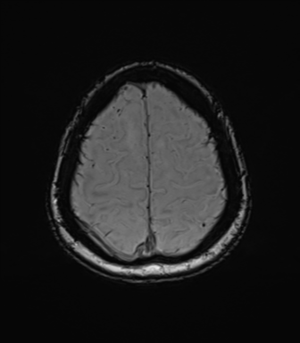 Anaplastic astrocytoma (Radiopaedia 86943-103160 Axial SWI 75).png