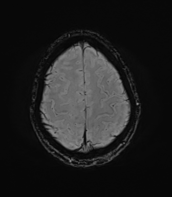 File:Anaplastic astrocytoma IDH mutant (Radiopaedia 50046-55341 Axial SWI 73).png