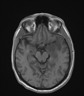 Anaplastic astrocytoma IDH wild-type (Radiopaedia 49984-55273 Axial T1 24).png