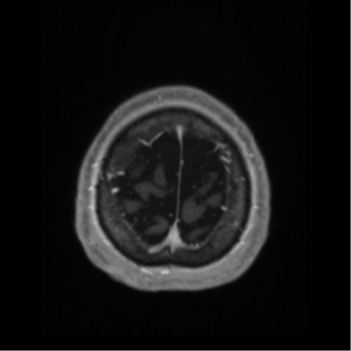 Anaplastic astrocytoma IDH wild-type (pseudoprogression) (Radiopaedia 42209-45276 Axial T1 C+ 134).png