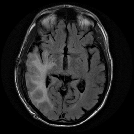 File:Anaplastic meningioma with recurrence (Radiopaedia 34452-35791 Axial FLAIR 10).png
