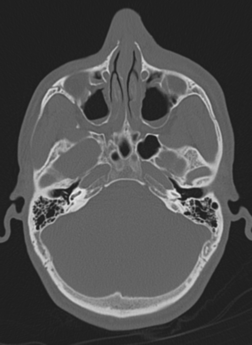 Anaplastic oligodendroglioma with skull fracture (Radiopaedia 74831-85846 Axial bone window 61).png