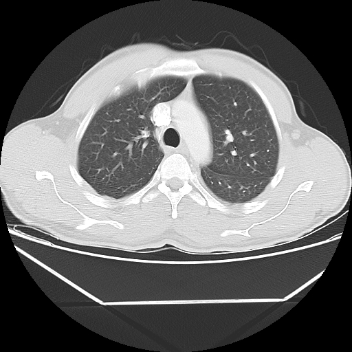 File:Aneurysmal bone cyst - rib (Radiopaedia 82167-96220 Axial lung window 25).jpg