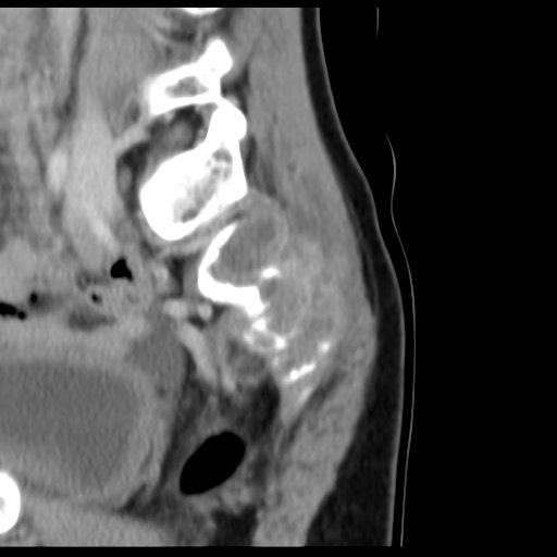 File:Aneurysmal bone cyst - sacrum (Radiopaedia 65190-74195 A 24).jpg