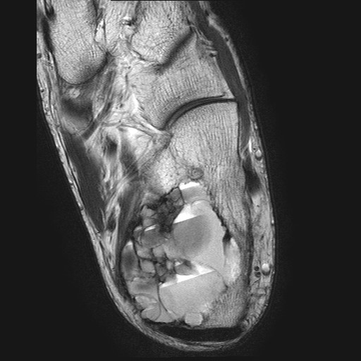 File:Aneurysmal bone cyst of the calcaneus (Radiopaedia 60669-68420 Axial T2 11).jpg