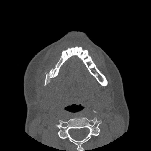 Aneurysmal bone cyst of the mandible (Radiopaedia 43280-46823 Axial bone window 39).jpg
