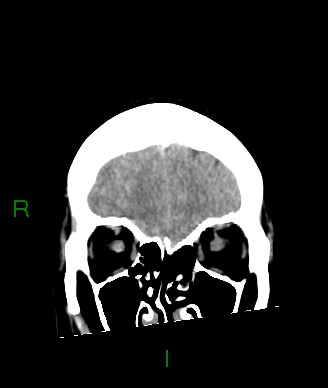 Aneurysmal subarachnoid hemorrhage with intra-axial extension (Radiopaedia 84371-99699 Coronal non-contrast 55).jpg
