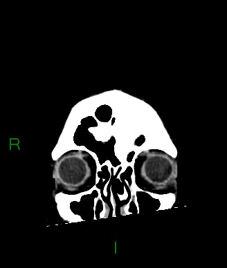 Aneurysmal subarachnoid hemorrhage with intra-axial extension (Radiopaedia 84371-99699 Coronal non-contrast 60).jpg