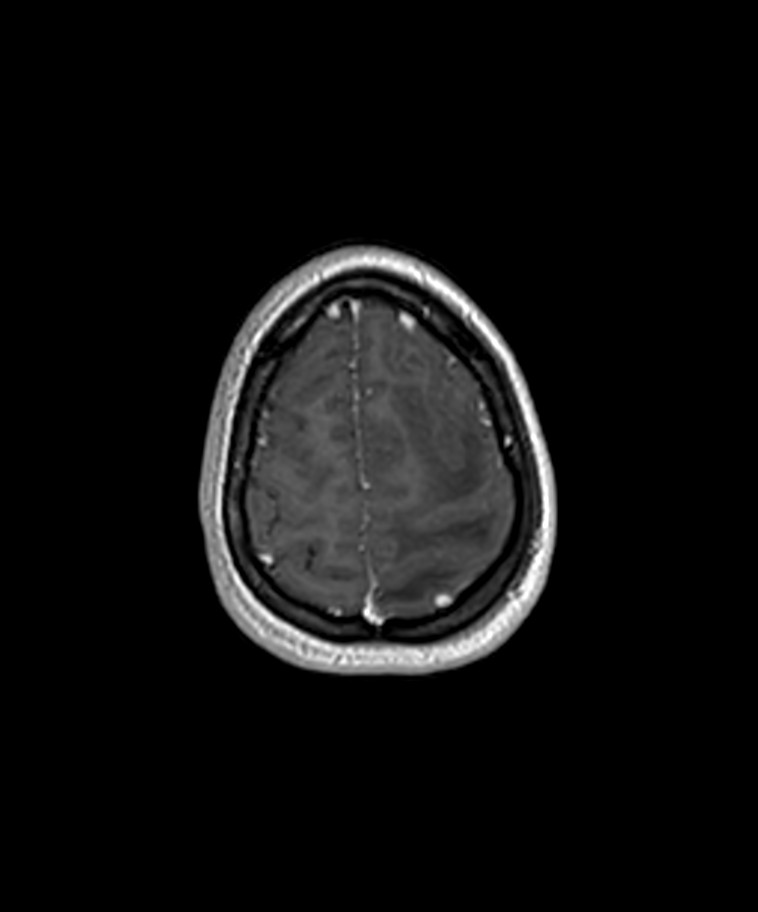 Angiomatous meningioma (Radiopaedia 79459-92577 Axial T1 C+ 3D ISO 56).jpg