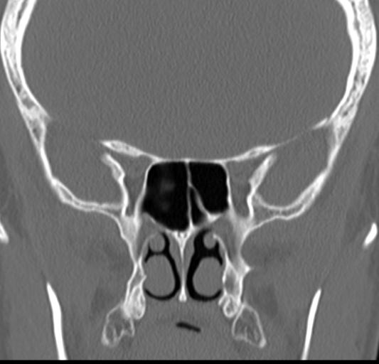 Angular epidermoid cyst (Radiopaedia 46908-51439 Coronal bone window 40).png