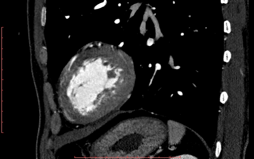 File:Anomalous left coronary artery from the pulmonary artery (ALCAPA) (Radiopaedia 70148-80181 C 211).jpg