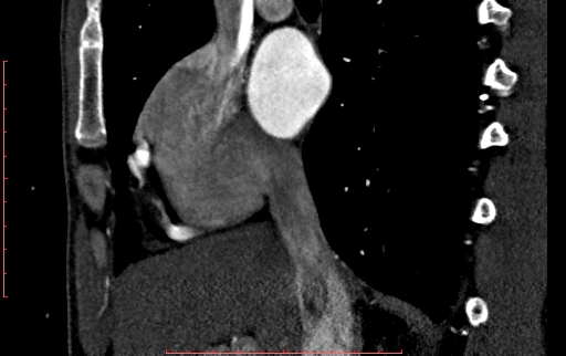 File:Anomalous left coronary artery from the pulmonary artery (ALCAPA) (Radiopaedia 70148-80181 C 45).jpg
