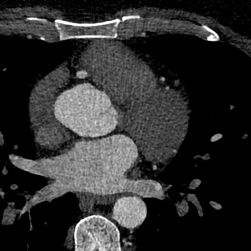 File:Anomalous origin of the left coronary artery with malignant course (Radiopaedia 77842-90126 C 74).jpeg