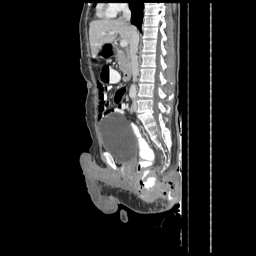 File:Anorectal carcinoma (Radiopaedia 44413-48064 C 50).jpg