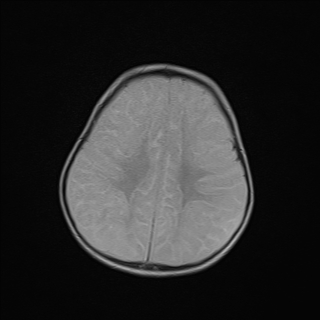 File:Anoxic brain injury (Radiopaedia 79165-92139 Axial FLAIR 20).jpg