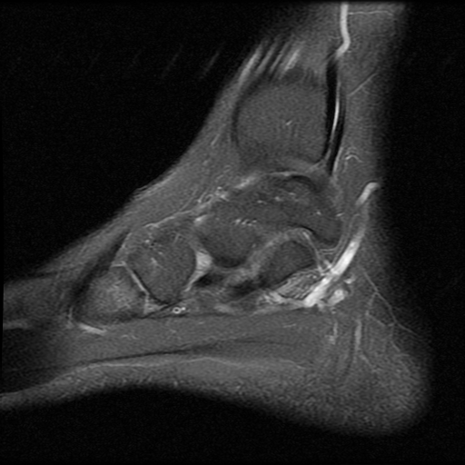 File:Anterior calcaneal process fracture (Radiopaedia 74654-85611 Sagittal PD fat sat 4).jpg