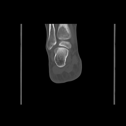 File:Anterior calcaneal process fracture (Radiopaedia 82590-96762 Coronal bone window 60).jpg