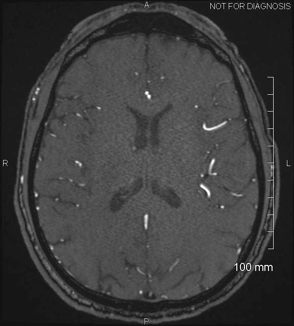 Anterior cerebral artery aneurysm (Radiopaedia 80683-94127 Axial MRA 147).jpg