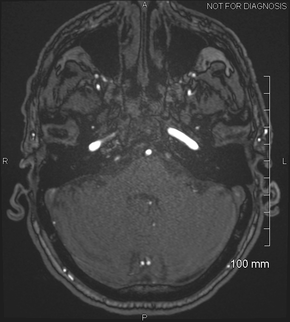 Anterior cerebral artery aneurysm (Radiopaedia 80683-94127 Axial MRA 48).jpg
