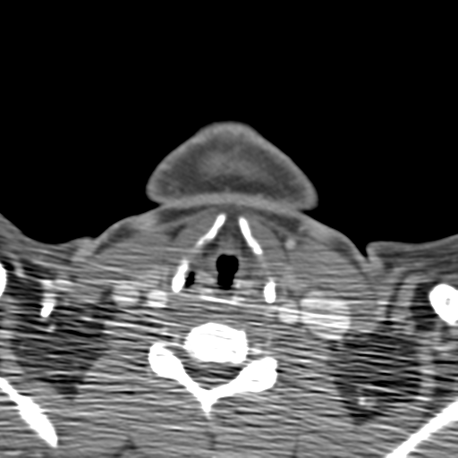 Anterior cerebral artery territory infarct (Radiopaedia 39327-41581 B 84).png