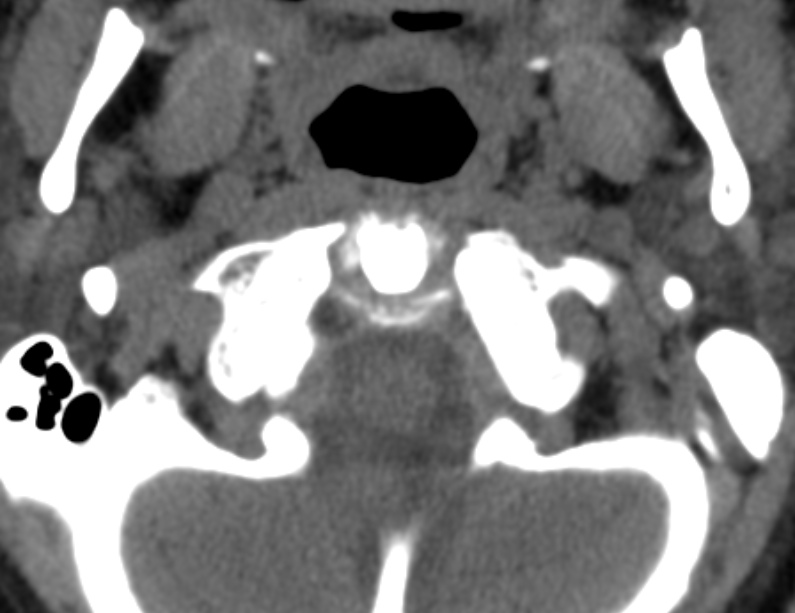 Anterior cervical postdiscectomy arthrodesis (Radiopaedia 32678-33646 Axial non-contrast 11).jpg