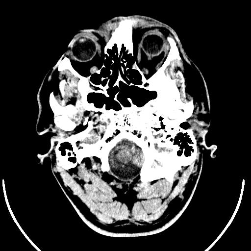 Anterior choroidal artery infarct (Radiopaedia 55106-61480 Axial non-contrast 2).jpg