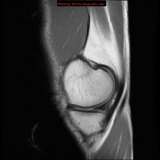 File:Anterior cruciate ligament injury - partial thickness tear (Radiopaedia 12176-12515 Sagittal PD 4).jpg