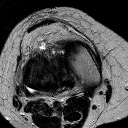 File:Anterior cruciate ligament mucoid degeneration (Radiopaedia 60853-68633 Axial T2 14).jpg