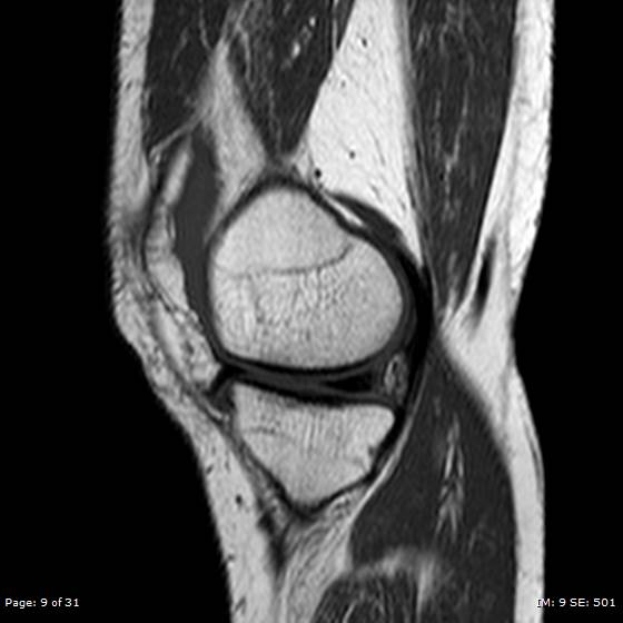 File:Anterior cruciate ligament tear (Radiopaedia 70783-80964 Sagittal T1 9).jpg