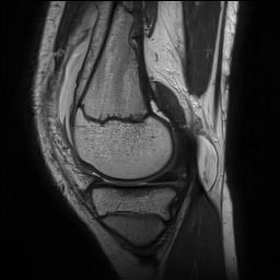 File:Anterior cruciate ligament tear - pediatric (Radiopaedia 62152-70260 Sagittal PD 58).jpg
