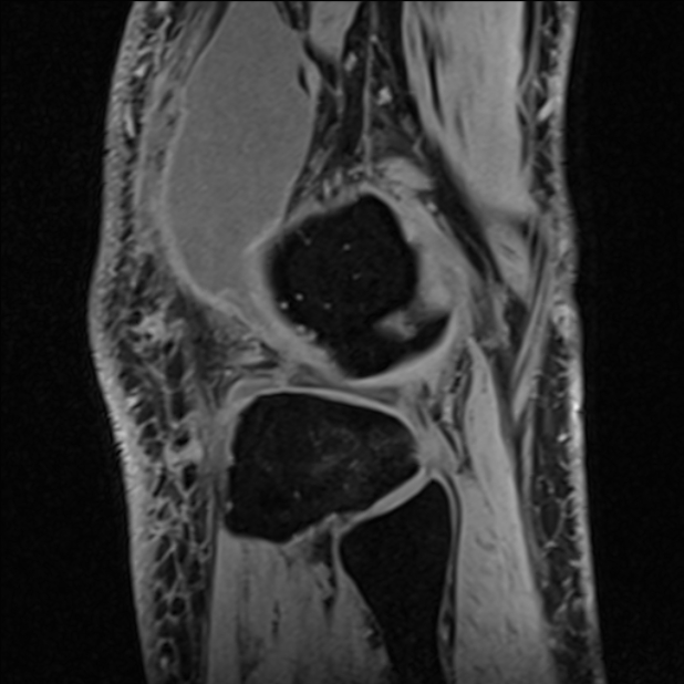 Anterior cruciate ligament tear - ramp lesion (Radiopaedia 71883-82322 Sagittal T1 vibe 28).jpg