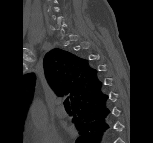 Anterior glenohumeral dislocation with Hill-Sachs lesion (Radiopaedia 62877-71249 Sagittal bone window 74).jpg