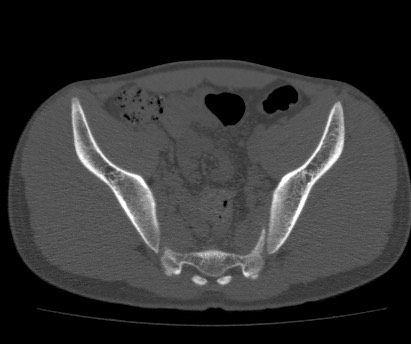 Anterior inferior iliac spine avulsion fracture (Radiopaedia 81312-94999 Axial bone window 37).jpg