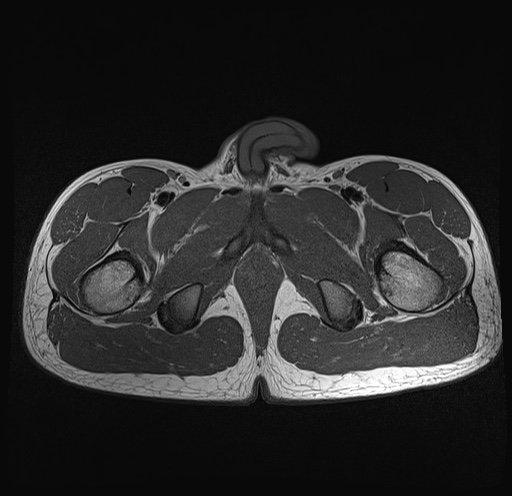 File:Anterior inferior iliac spine avulsion fracture (Radiopaedia 81312-95000 Axial T1 5).jpg