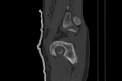 Anterior inferior iliac spine avulsion injury (Radiopaedia 88666-105376 Sagittal bone window 35).jpg