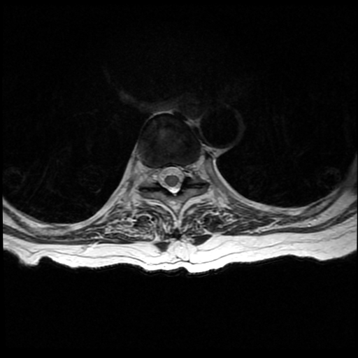 File:Anterior spinal artery syndrome (Radiopaedia 46335-50750 Axial T2 19).png
