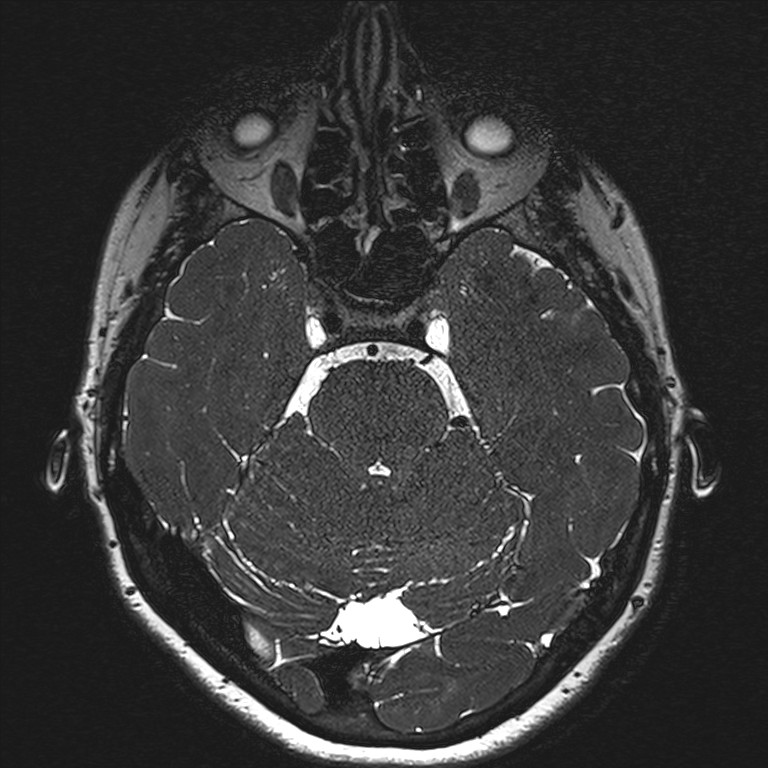 Anterior temporal encephalocele (Radiopaedia 82624-96808 Axial T2 high res 51).jpg