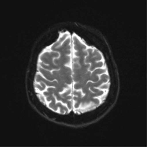 Anterior temporal lobe perivascular space (Radiopaedia 40946-43650 Axial DWI 22).png
