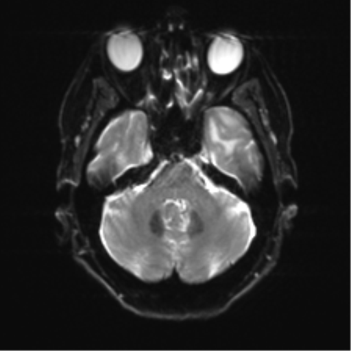 Anterior temporal pole cysts (Radiopaedia 46629-51102 Axial DWI 7).png
