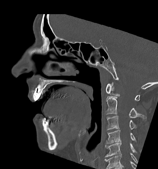 Anterior temporomandibular joint dislocation (Radiopaedia 59430-66784 B 28).jpg