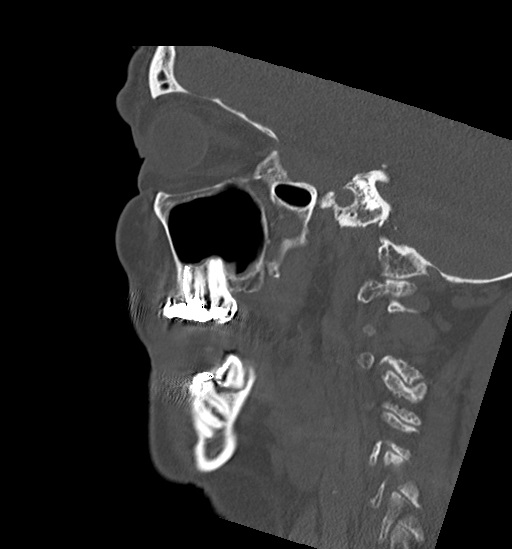 Anterior temporomandibular joint dislocation (Radiopaedia 59430-66784 B 44).jpg