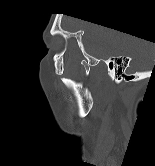 File:Anterior temporomandibular joint dislocation (Radiopaedia 59430-66784 B 9).jpg