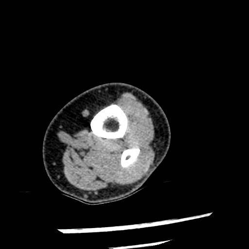 Anterior tibial artery false aneurysm (Radiopaedia 88984-105809 A 3).jpg
